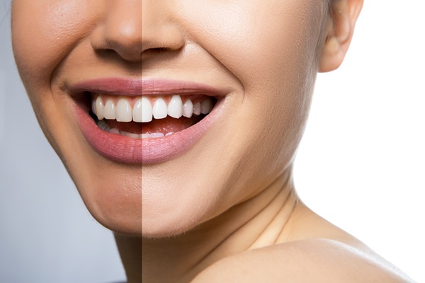 Can Teeth Be Sensitive After Teeth Whitening?